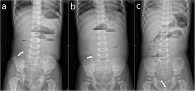 Pediatric Multiple High-Powered Magnetic Buckyballs Ingestion—Experience From Six Tertiary Medical Centers